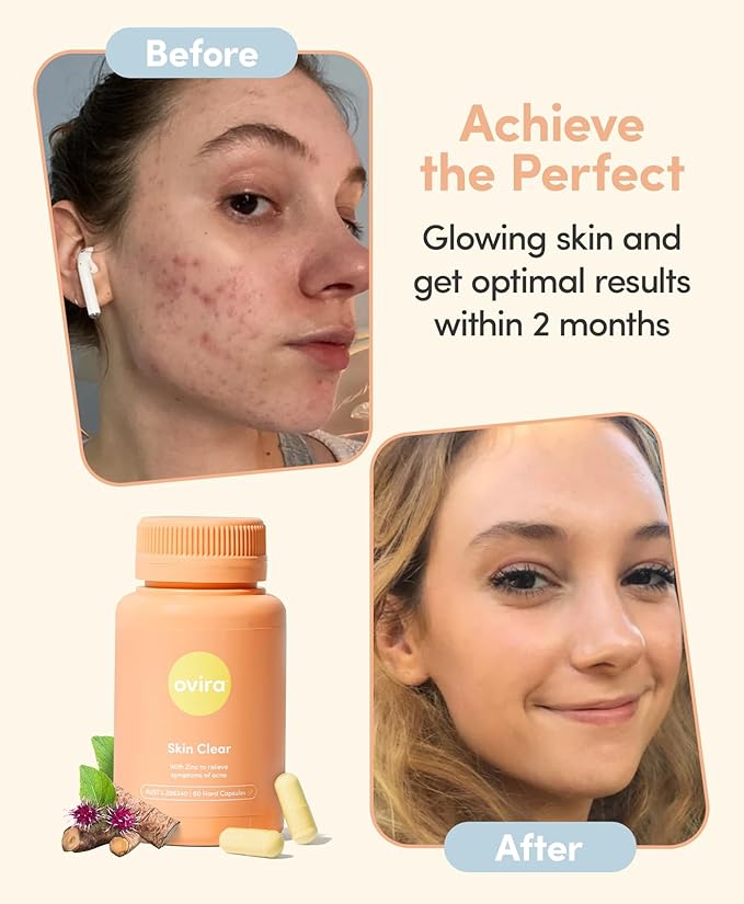 Ovira Skin Clear with ZINCBRIGHT - 60 Capsules for Clear &amp Glowing Skin | Rosacea &amp Hormonal Acne Treatment with Vitamin C | Support Collagen Production | Acne Supplements for Women &amp Men
