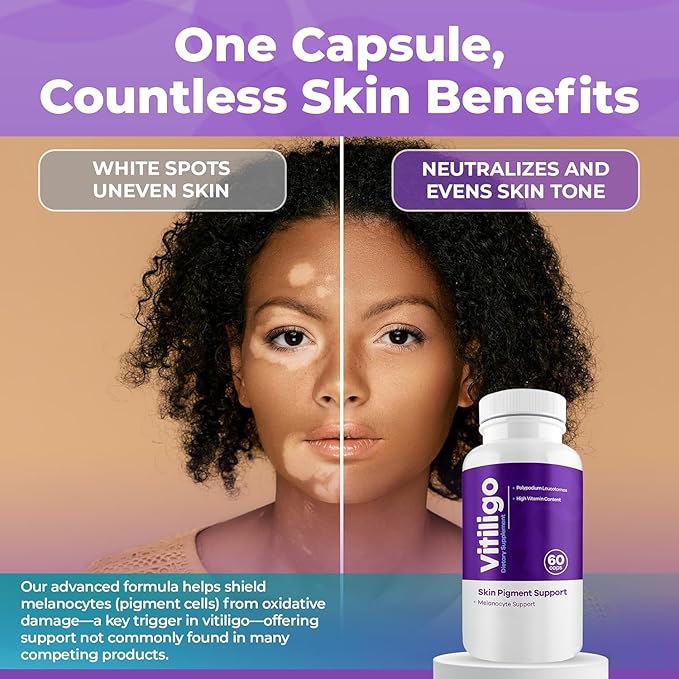 Vitiligo Capsules 60 Count | 1 Month | Improve Skin Pigmentation Support and Reduce White Spots | Effective Vitiligo Supplement | Natural Solution for White Spots on Skin. (2)