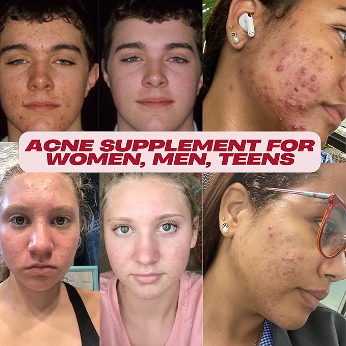 Acne Pills- Vitamin Supplements for Acne Treatment- Natural Clear Skin from Hormonal Cystic Pimples- Oily Skin Vitamins Pill for Women Teen Men &amp Adults 60 Tablets